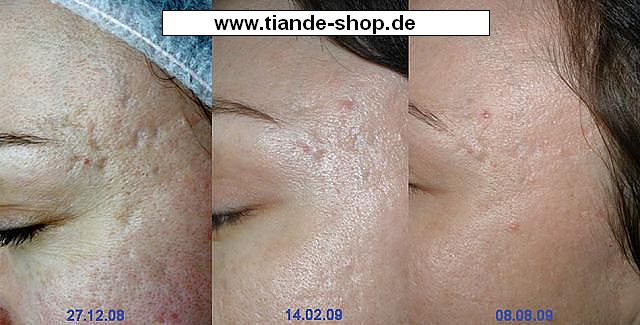 Ja gedeihen jene Mädchen bei wem die Ohrringe und auf der Nase der Sommersprosse