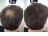 Lichtes,  dünnes Haar? Haarprobleme? Haarausfall?  Hairfor2 hilft….