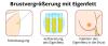 Sponsor für Brustvergrößerung mit Eigenfett gesucht