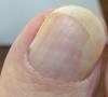 Beschädigter durch Nagelpilz Fußnagel in 15 Min. mit dem Fußnagel Spray/ Jenn Cos