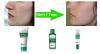 Serie gegen Akne Natur-Kosmetik - effektiv gegen Pickeln,  Mitesser und Narben