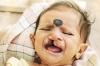 Cleft-Kinder-Hilfe durch Professor Sailer