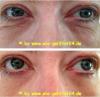 Faltenfrei in wenigen Minuten,  Anti-Aging der neuen Ära,  Sofort-Lifting pur!