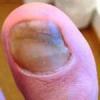 Beschädigter durch Nagelpilz Fußnagel in 15 Min. mit dem Fußnagel Spray/ Jenn Cos